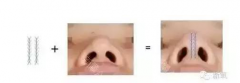 线雕隆鼻还是玻尿酸隆